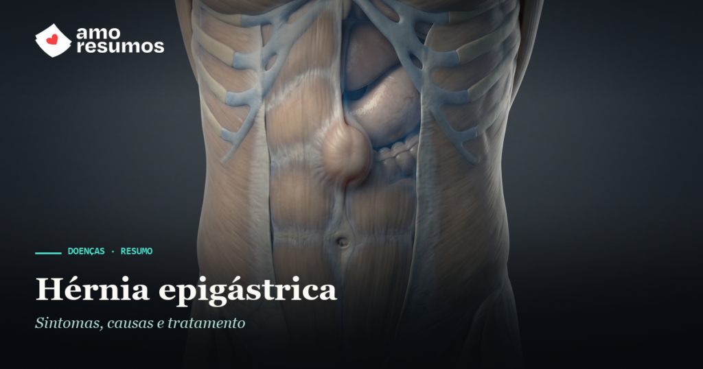 Hérnia epigástrica — ilustração — Amo Resumos