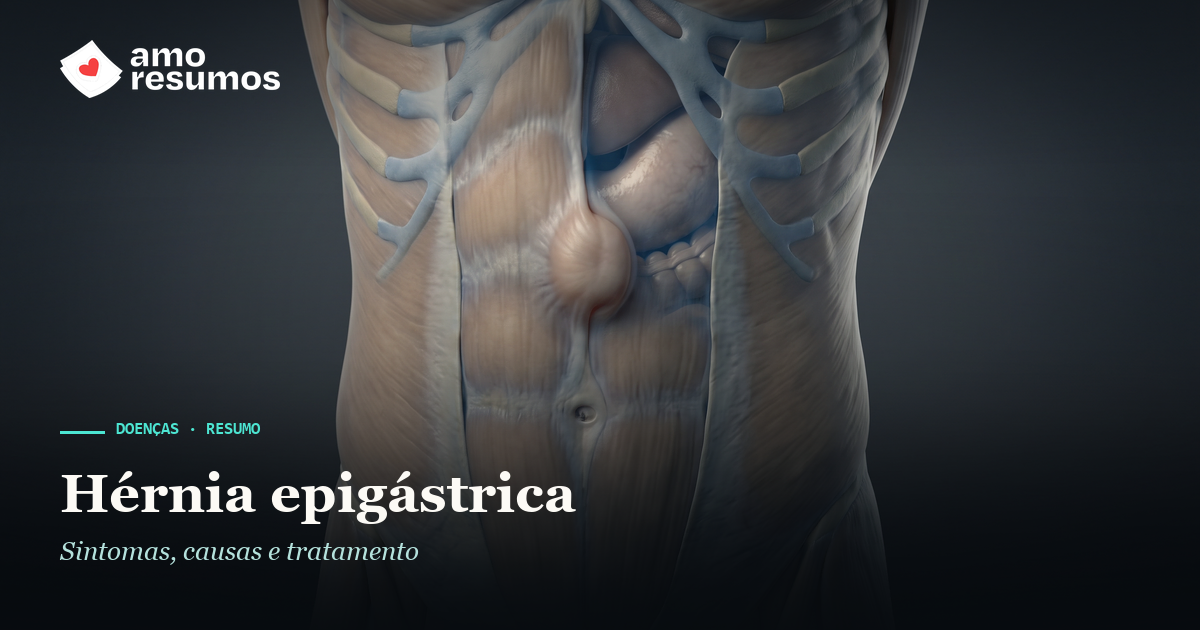 Hérnia epigástrica — ilustração — Amo Resumos