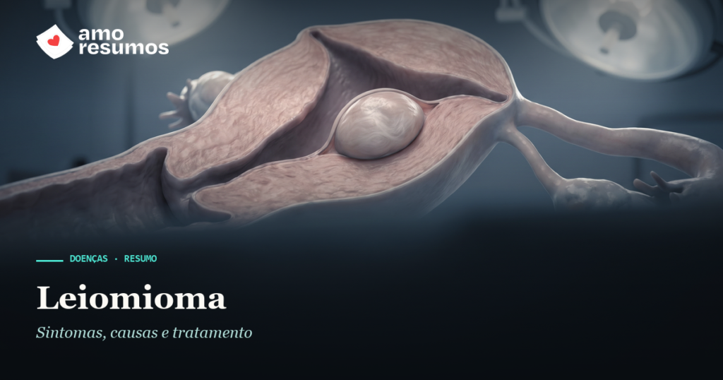 Leiomioma — ilustração — Amo Resumos