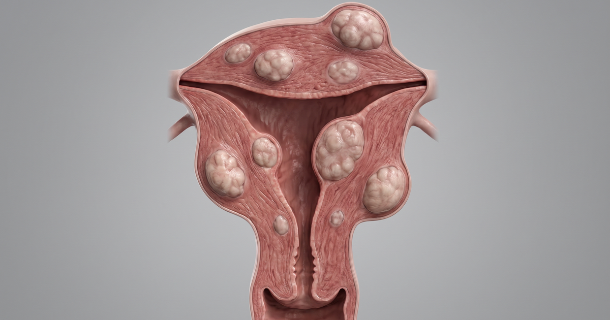 Miomatose uterina — ilustração — Amo Resumos