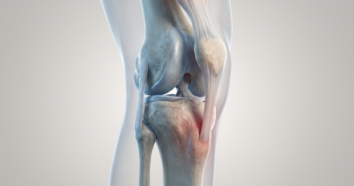 Doença de Osgood-Schlatter — ilustração — Amo Resumos