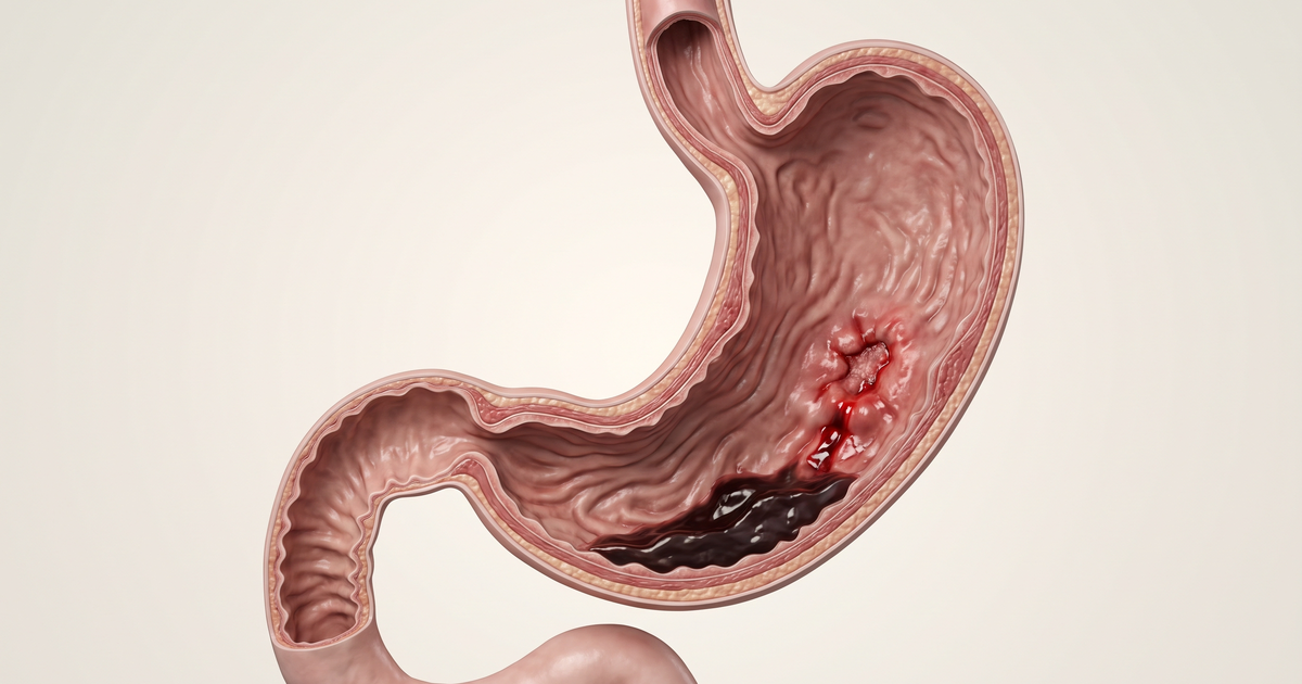 Diferença entre hematêmese, melena e hematoquezia — Amo Resumos