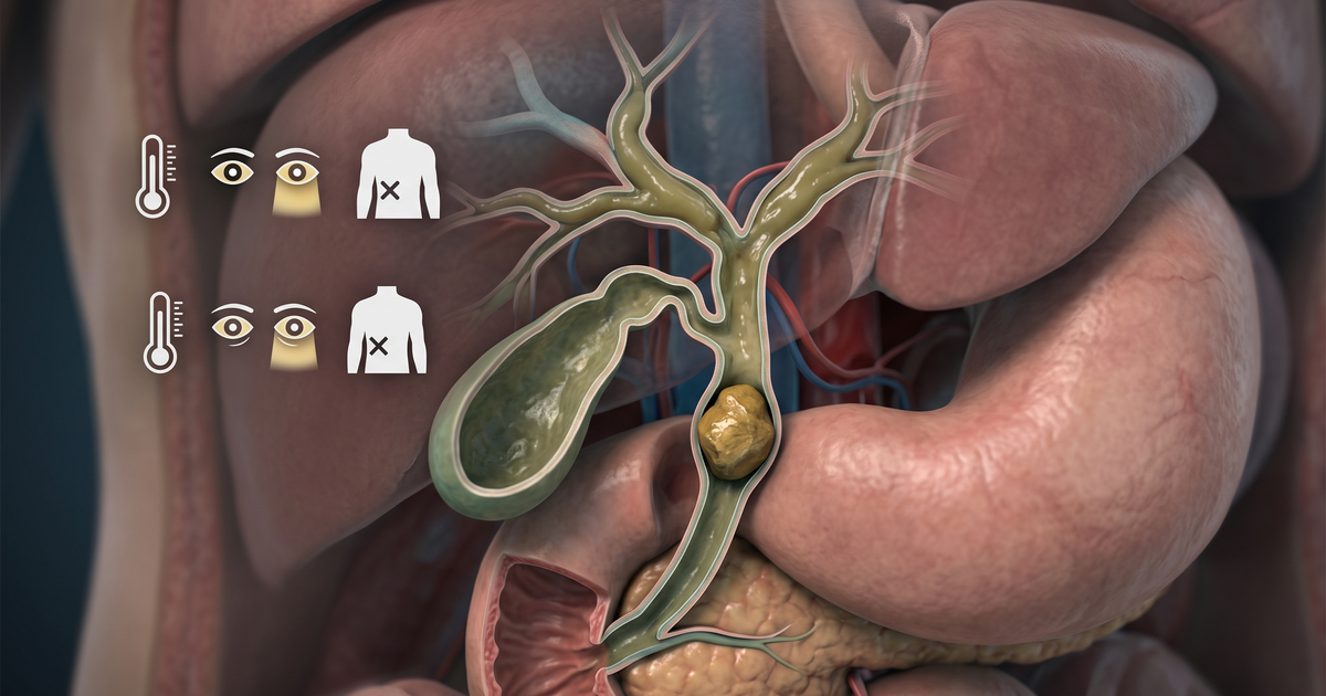 Colangite aguda: obstrução + infecção das vias biliares (tríade de Charcot) — ilustração Amo Resumos