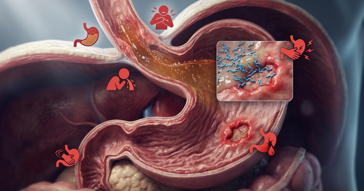 DRGE (refluxo ácido) e úlcera péptica com H. pylori, e os sinais de alarme — Sindrômica Visual