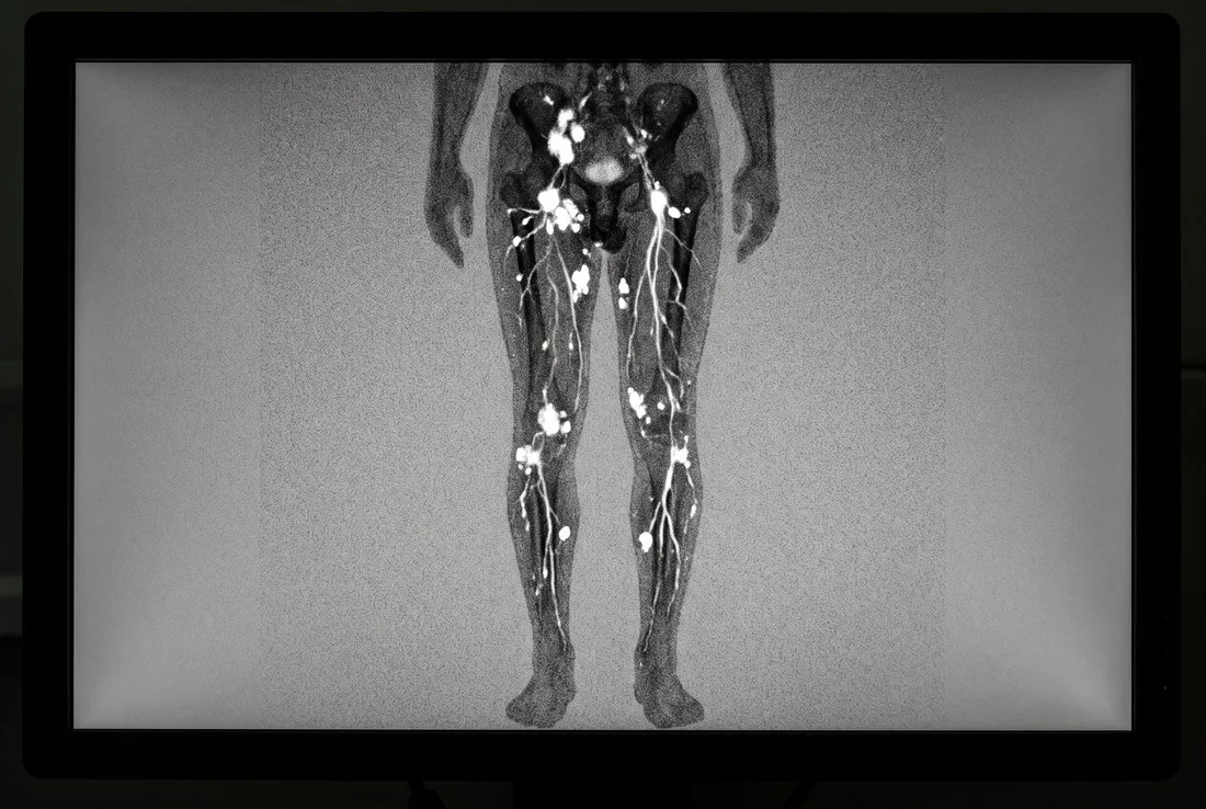 Métodos: da clínica à linfocintilografia