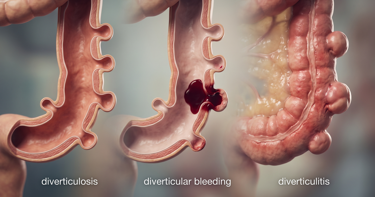 Doença diverticular: diverticulose, sangramento diverticular e diverticulite — esquema Amo Resumos