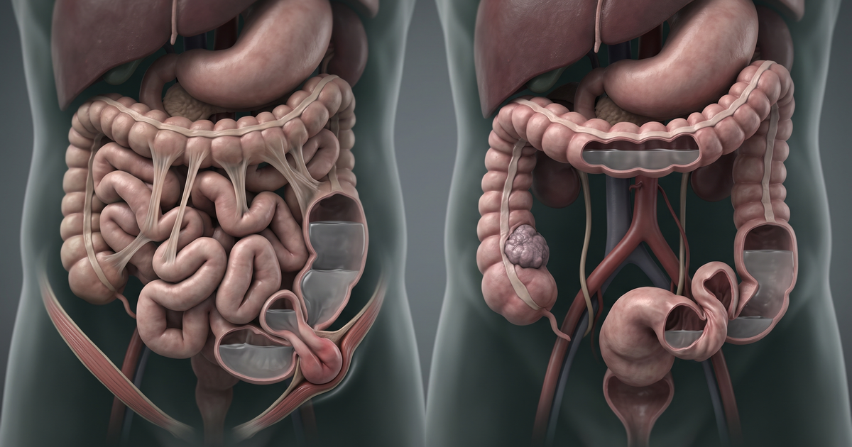 Abdome agudo obstrutivo: obstrução de delgado (bridas, hérnias) × cólon (tumor, volvo) — esquema Amo Resumos